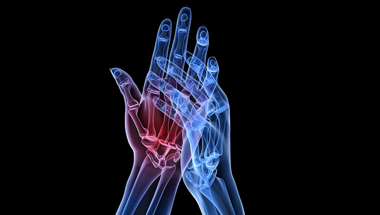 Rheumatoid Arthritis